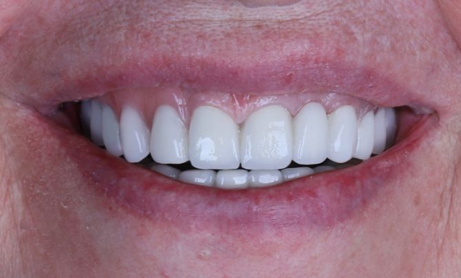 After (Teeth)