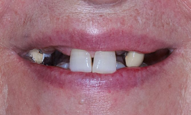 Before (Teeth)