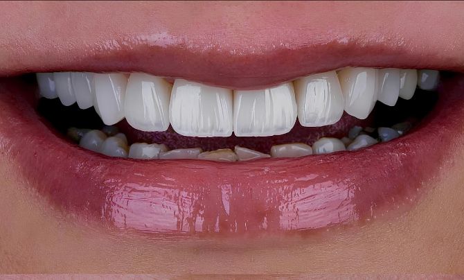 After (Teeth)