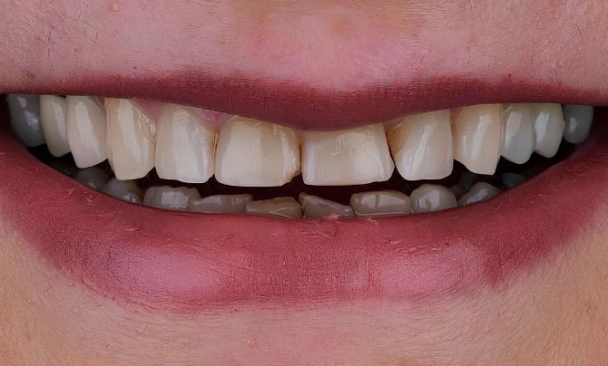 Before (Teeth)