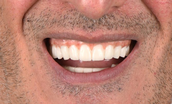 After (Teeth)