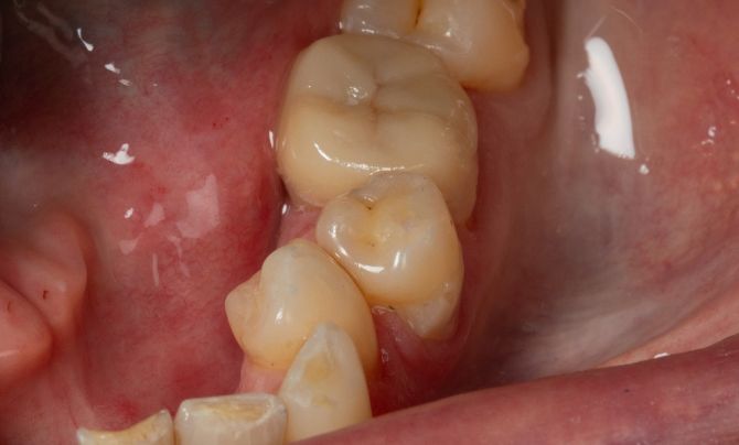 After (Teeth)