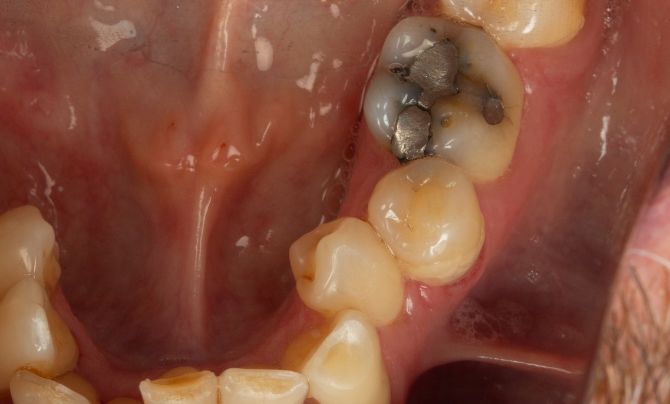 Before (Teeth)