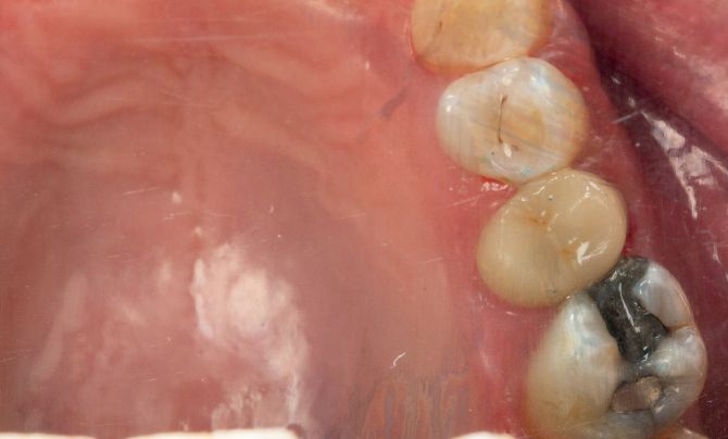 After (Teeth)