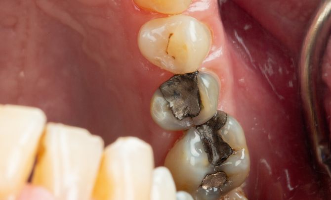 Before (Teeth)